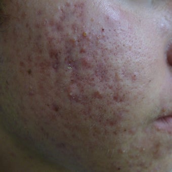eMartix for acne and early scars before 1824596