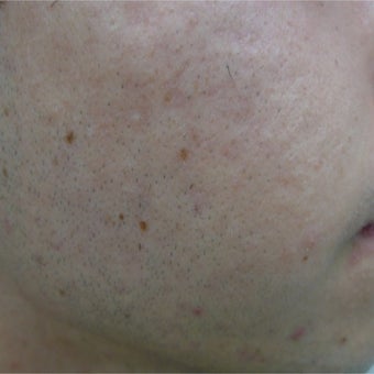 eMartix for acne and early scars after 1824596