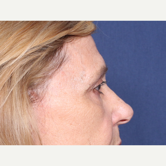 65-74 year old woman treated with Eyelid Surgery (view 2 of 2) before 3181153
