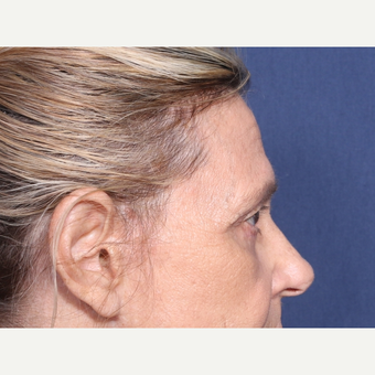 65-74 year old woman treated with Eyelid Surgery (view 2 of 2) after 3181153