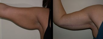 Arm Lift before 1233003