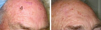 Mole Removal photos before 951877