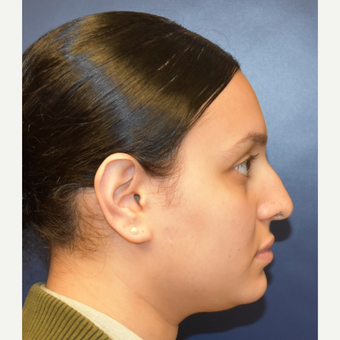 18-24 year old woman treated with Septoplasty before 2979666