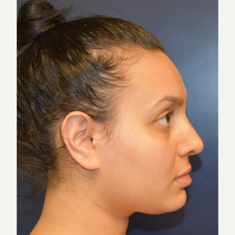18-24 year old woman treated with Septoplasty after 2979666