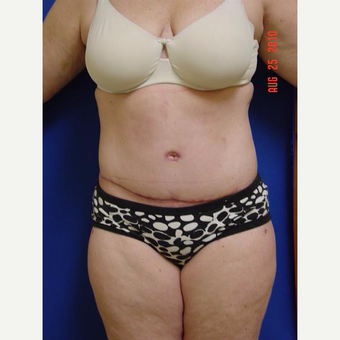 35-44 year old woman treated with Tummy Tuck after 3225802