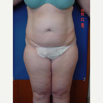 35-44 year old woman treated with Tummy Tuck before 3225802