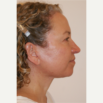 45-54 year old woman treated with Facelift after 3419953