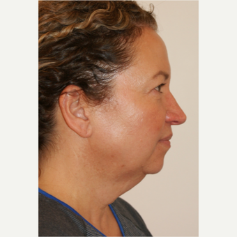 45-54 year old woman treated with Facelift before 3419953