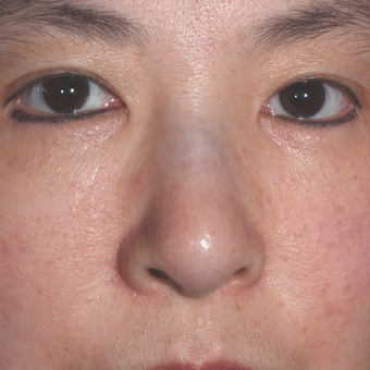 previous silicone injections - material moved making nose look worse after 3679370