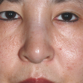 previous silicone injections - material moved making nose look worse before 3679370