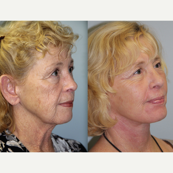 65 year old woman treated with Neck Lift before 3315751