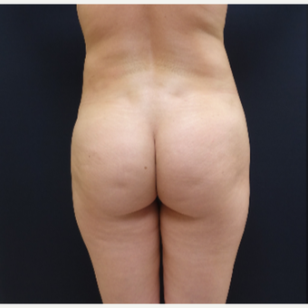 25-34 year old woman treated with 712cc Round Silicone Butt Implants before 3259530
