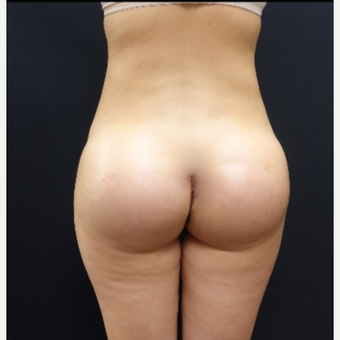 25-34 year old woman treated with 712cc Round Silicone Butt Implants after 3259530