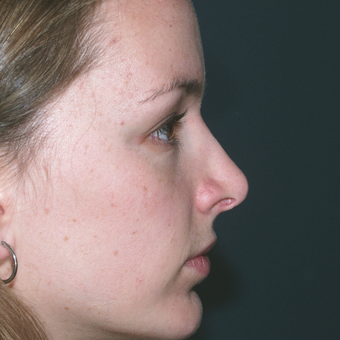 Chin weakness can impact the appearance of one's nose and profile view after 3679424