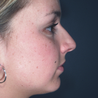 Chin weakness can impact the appearance of one's nose and profile view before 3679424
