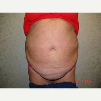 45-54 year old woman treated with Liposuction before 1595343