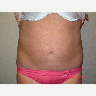 45-54 year old woman treated with Liposuction after 1595343