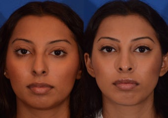 18-24 year old woman treated with Rhinoplasty before 2132923