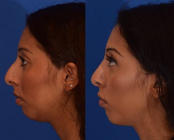 18-24 year old woman treated with Rhinoplasty after 2132923