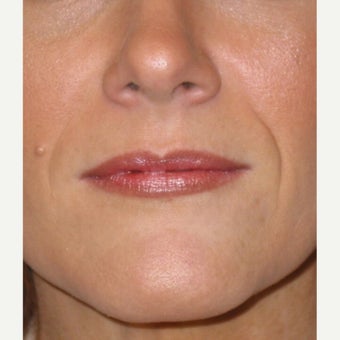35-44 year old woman treated with Juvederm before 1755089