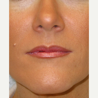 35-44 year old woman treated with Juvederm after 1755089