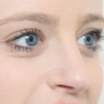 18-24 year old woman treated with Rhinoplasty after 3566049