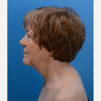 71 year old woman treated with Chin Liposuction and Laser Skin Tightening after 3093631