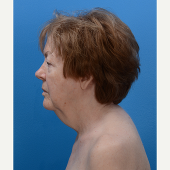 71 year old woman treated with Chin Liposuction and Laser Skin Tightening before 3093631