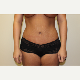 Tummy tuck after 3417583