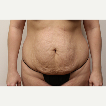 Tummy tuck before 3417583