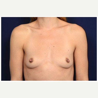 25-34 year old woman treated with Mentor Breast Implants before 3383423