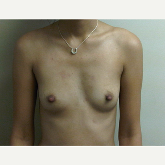 High Profile Silicone Cohesive Gel Implants before 3840162