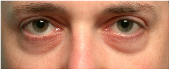 Restylane to lower eyelid hollows before 219713