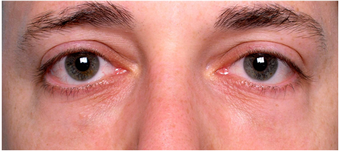 Restylane to lower eyelid hollows after 219713