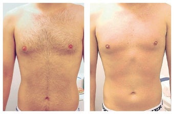 Laser Hair Removal of Male Chest and Abdomen before 1112357