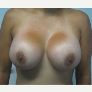 Breast Augmentation after 3054769