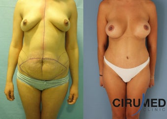 Supercharged Breast Augmentation before 1285084