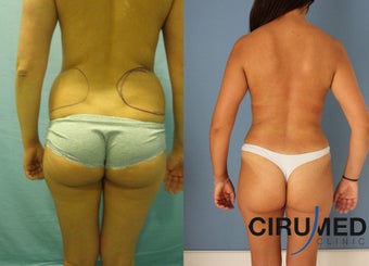 Supercharged Breast Augmentation after 1285084