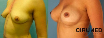 Supercharged Breast Augmentation 1285084