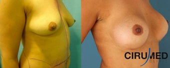 Supercharged Breast Augmentation 1285084
