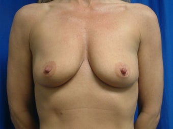 Breast Augmentation with Gummy Bear Implants before 1459175