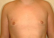 Liposuction for Gynecomastia after 74777