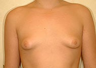 Liposuction for Gynecomastia before 74777