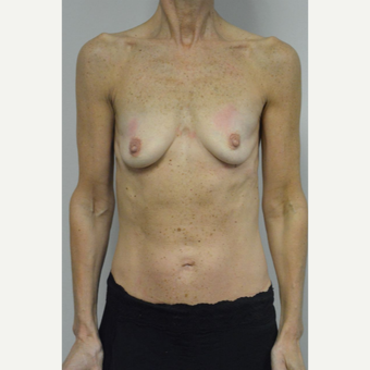 55-64 year old woman treated with Breast Implants before 3055543