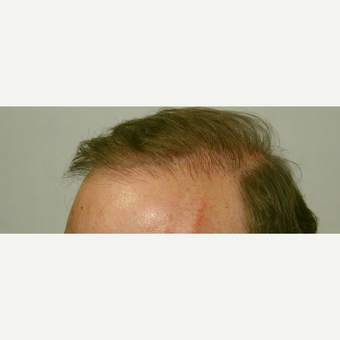 Hair Transplant after 3241408