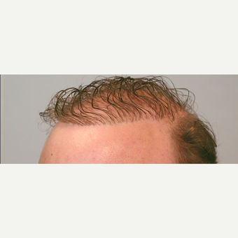 Hair Transplant before 3241408
