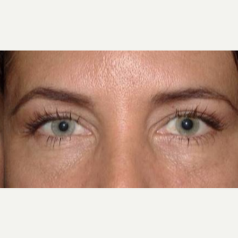 55-64 year old woman treated with Eyelid Surgery after 3170591