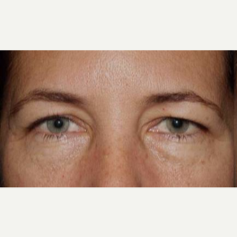 55-64 year old woman treated with Eyelid Surgery before 3170591