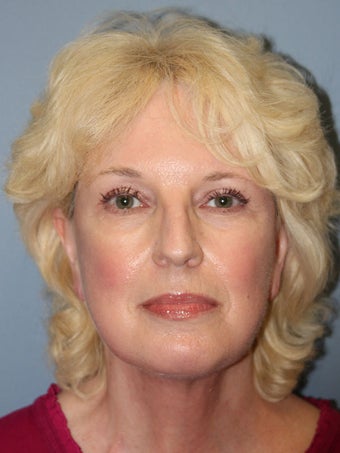 Chemical Peel - Blue Peel after 956781