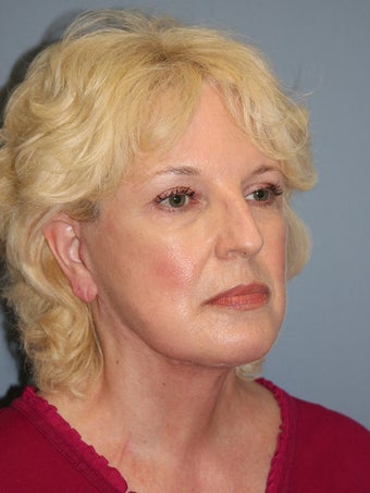 Chemical Peel - Blue Peel 956781